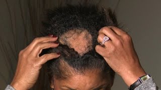 What Is Causing This Woman’s Extreme Hair Loss [upl. by Nylirrehs]